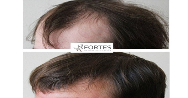 hair loss treatment