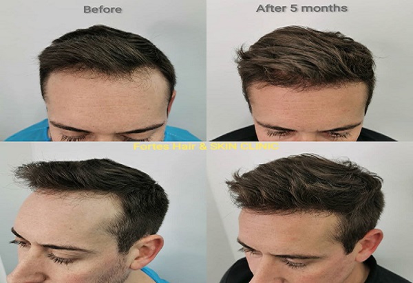 Hair Loss Treatment for men