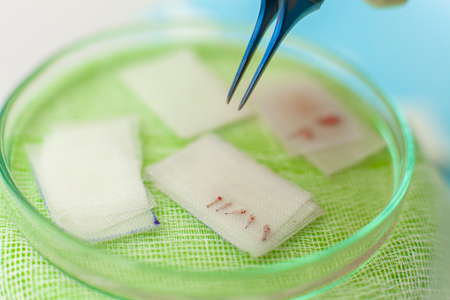 PRP hair treatment