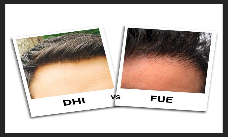 FUE Hair transplant