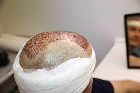 hair transplant in Turkey