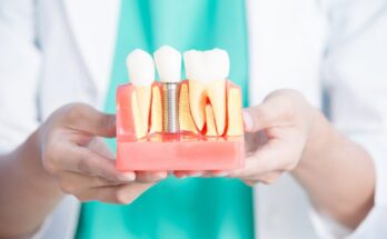 Ceramic Implants For Teeth