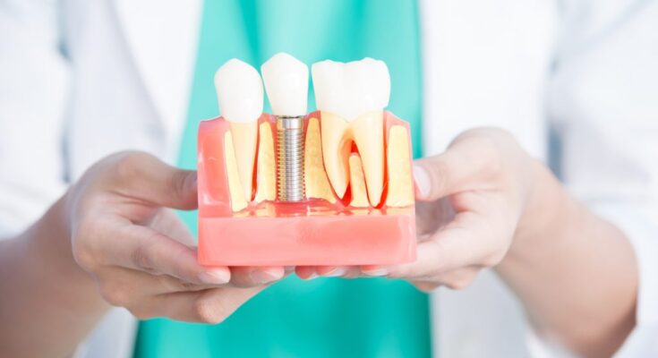 Ceramic Implants For Teeth