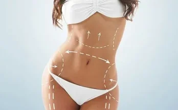 Tummy Tuck Treatment Dubai