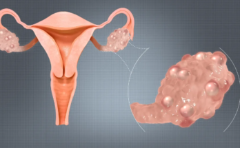 Best PCOS doctor in Dubai