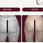 Buttock Fat Grafting